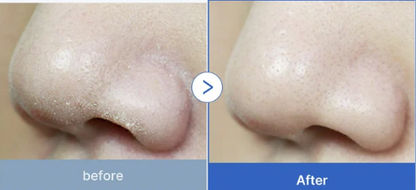 MEDICUBE-ESPUMA LIMPIADORA ZERO FOAM CLEANSER [120 G ]